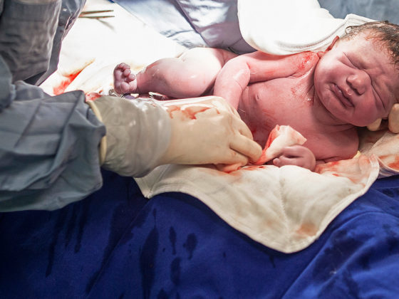 Photo d'un bébé né par césarienne